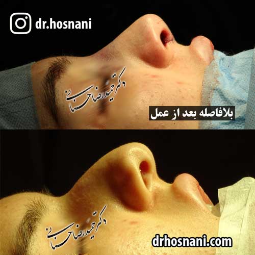 najim rhinoplasty in iran og