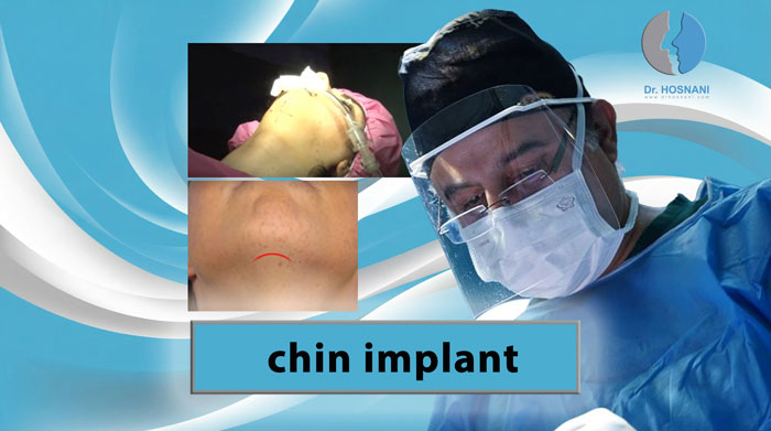 Chin Implant Surgery