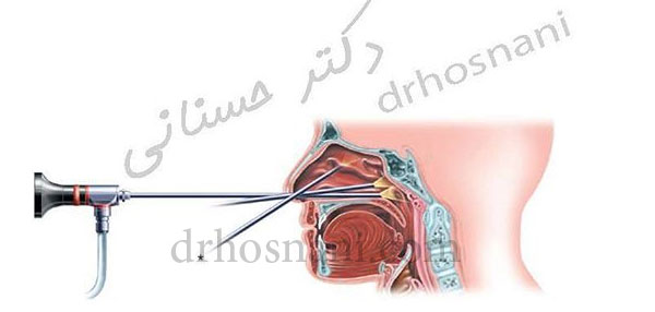 Endoscopic Sinus Surgery Simultaneously with Rhinoplasty