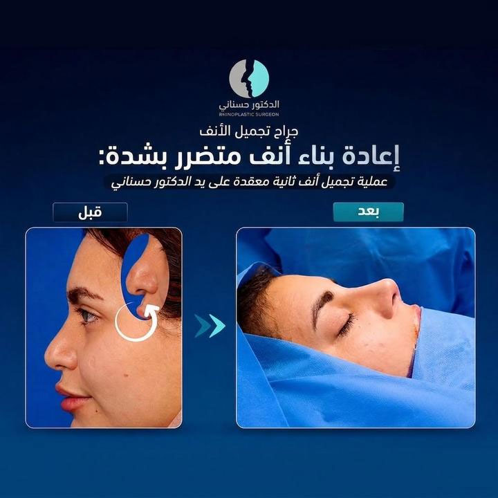 إعادة بناء أنف متضرر بشدة: عملية تجميل أنف ثانية معقدة على يد الدكتور حسناني