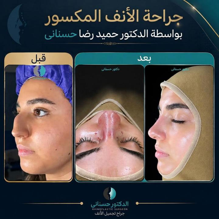 من سقوط الطفولة إلى أنف مثالي | عملية تجميل الأنف للدكتور حسناني