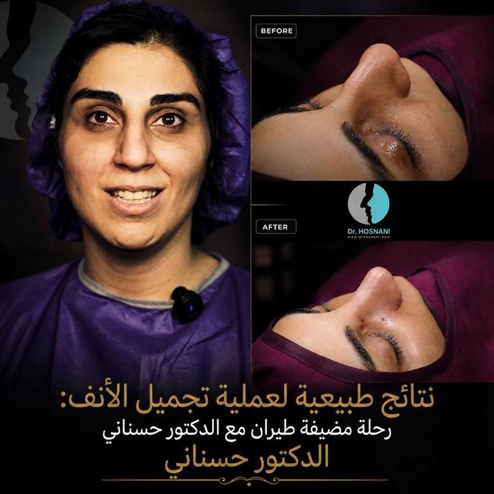 نتائج طبيعية لعملية تجميل الأنف: رحلة مضيفة طيران مع الدكتور حسناني