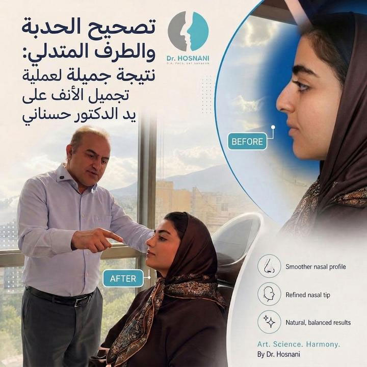 تصحيح الحدبة والطرف المتدلي: نتيجة جميلة لعملية تجميل الأنف على يد الدكتور حسناني