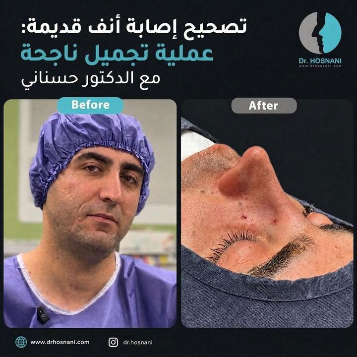تصحيح إصابة أنف قديمة: عملية تجميل ناجحة مع الدكتور حسناني