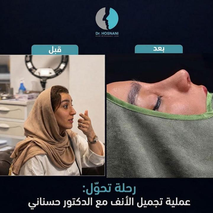 رحلة تحوّل: عملية تجميل الأنف مع الدكتور حسناني