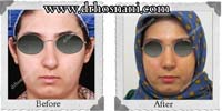 عمل بینی شماره 138غضروفی با پوست ضخیم