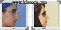عمل بینی شماره 139غضروفی با پوست ضخیم