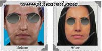 عمل بینی شماره 142گوشتی با غضروف های قوی
