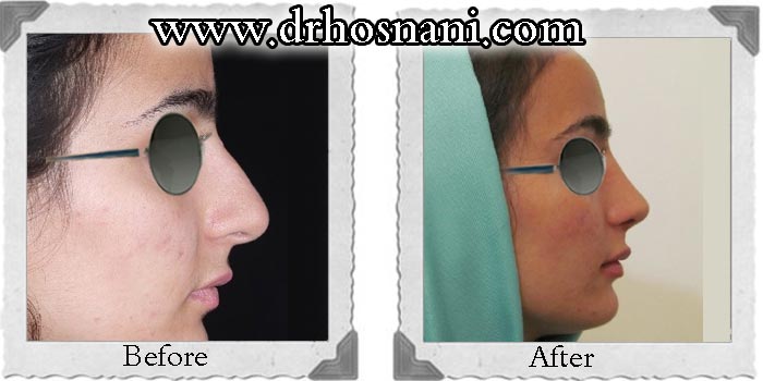 اصلاح سوراخ بینی