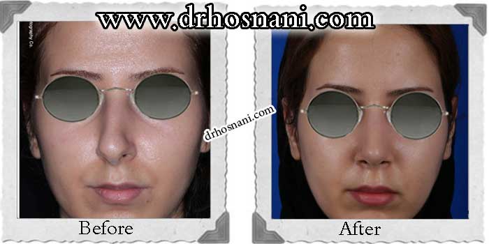 اصلاح سوراخ بینی