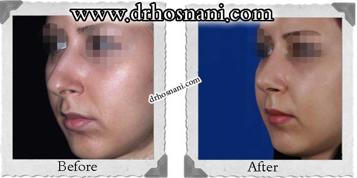 اصلاح سوراخ بینی