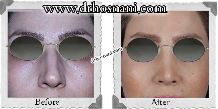اصلاح سوراخ بینی