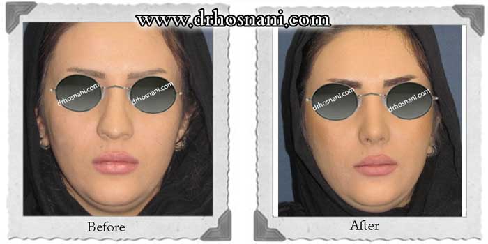 اصلاح سوراخ بینی