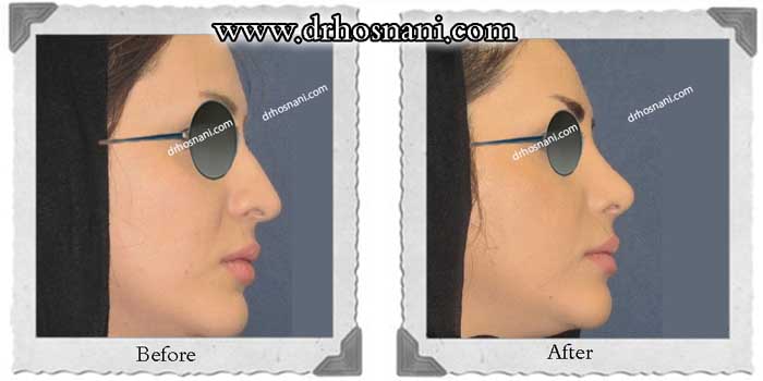 اصلاح سوراخ بینی