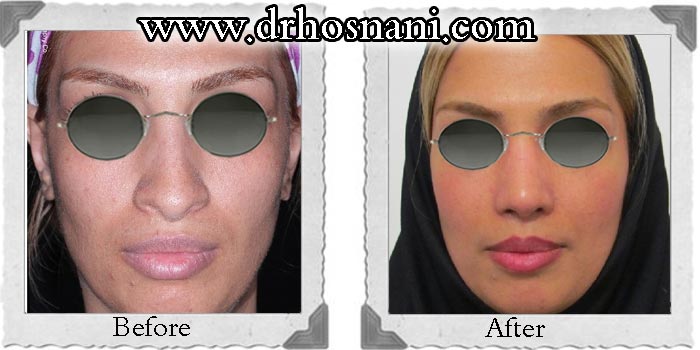 اصلاح سوراخ بینی