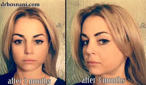 Cyra after rhinoplasty