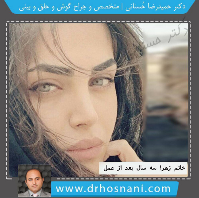 feminin nose job