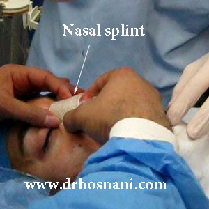 Nasal splint