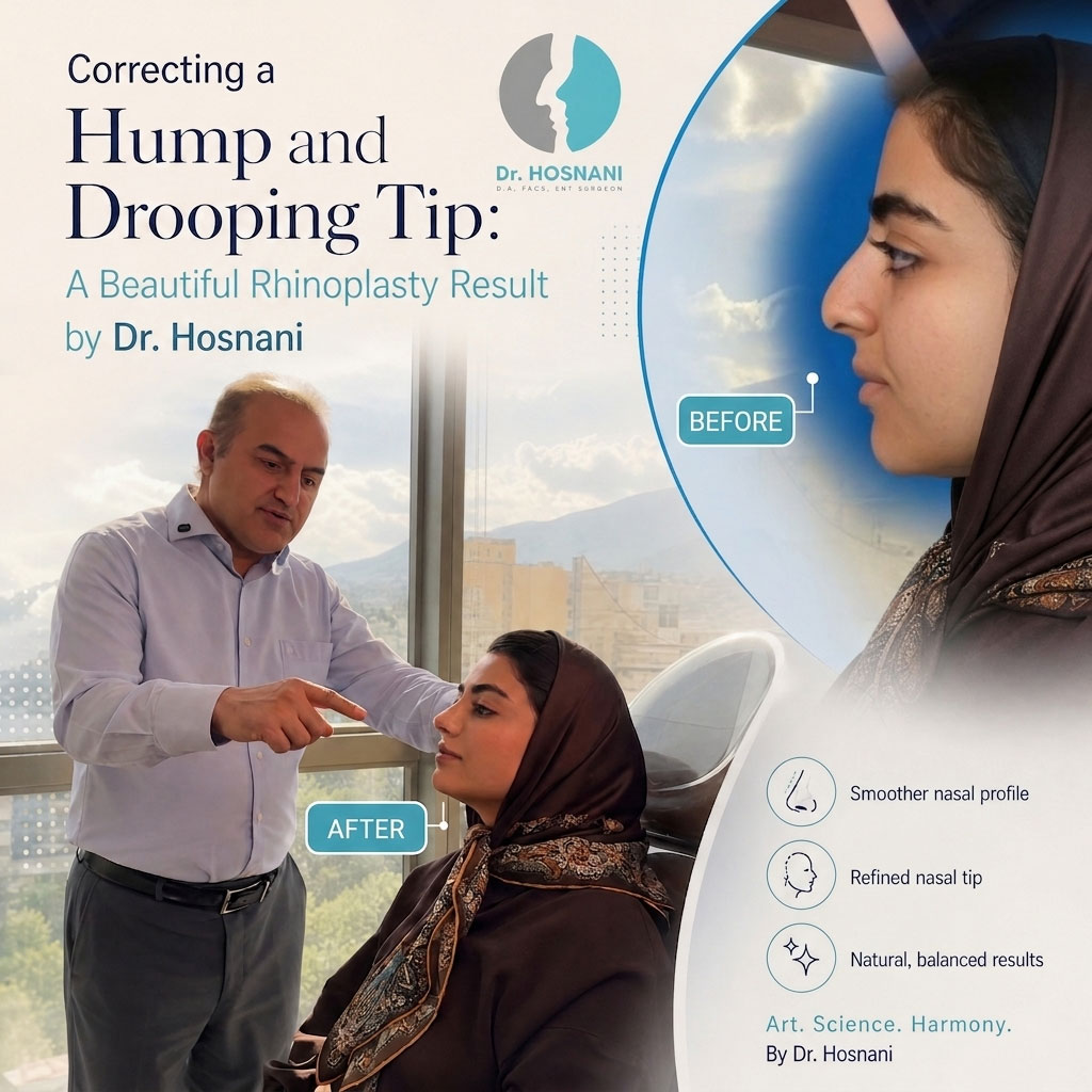 Correcting a Hump and Drooping Tip: A Beautiful Rhinoplasty Result by Dr. Hosnani
