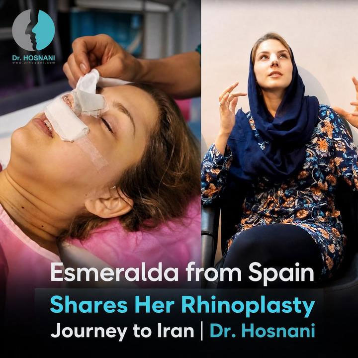 Esmeralda from Spain Shares Her Rhinoplasty Journey to Iran | Dr. Hosnani