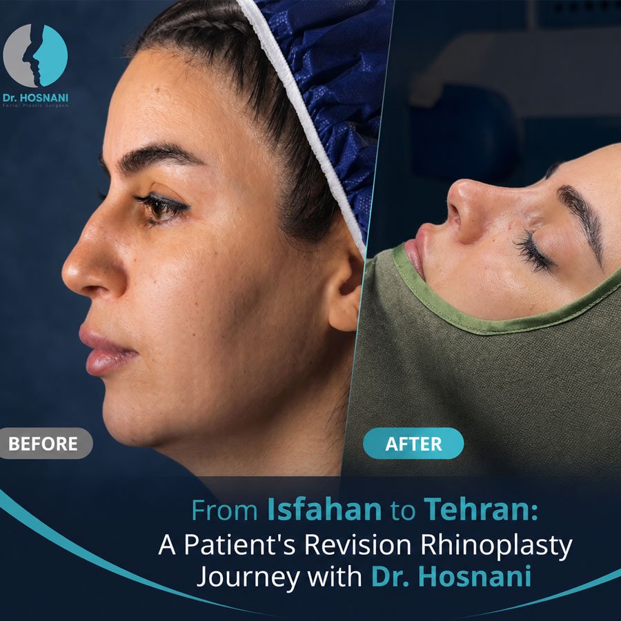 From Isfahan to Tehran: A Patient's Revision Rhinoplasty Journey with Dr. Hosnani