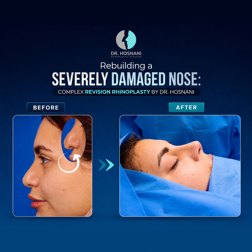 Rebuilding a Severely Damaged Nose: Complex Revision Rhinoplasty by Dr. Hosnani