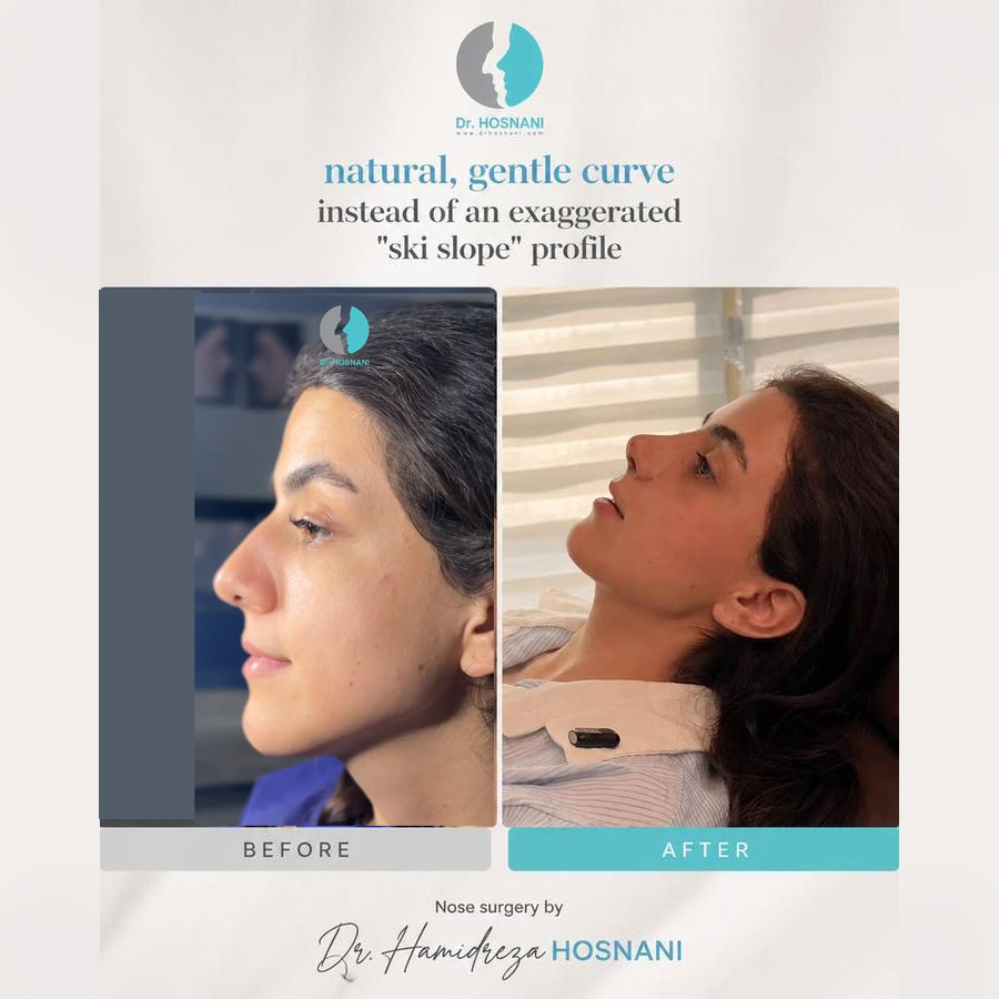 Defining Your Rhinoplasty Goals: A Consultation with Dr. Hosnani