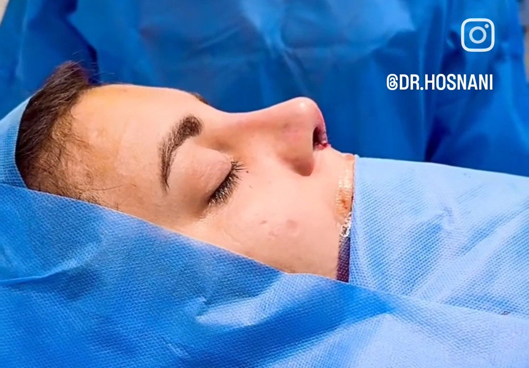 Nasal splint, nasal cast, nasal dressing, preventing nasal drip