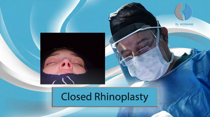 Advantages of Closed Rhinoplasty