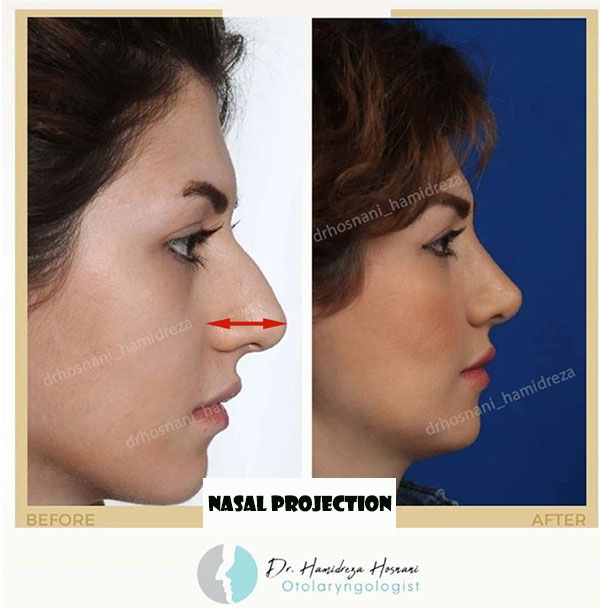 definition of nose height or projection