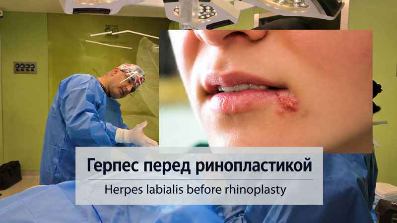 Herpes Before Rhinoplasty