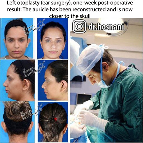 otoplasty drhosnani ear aesthetic surgery