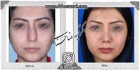 عمل بینی شماره 1001