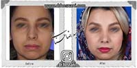 عمل بینی شماره 1003