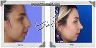 عمل بینی شماره 1004
