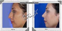 عمل بینی شماره 1008