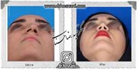 عمل بینی شماره 1009