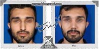 عمل بینی شماره 1011