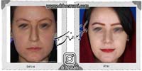 عمل بینی شماره 1013