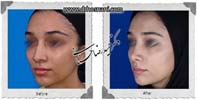 عمل بینی شماره 1018گوشتی با غضروف های قوی