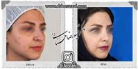  جراحی بینی -1019