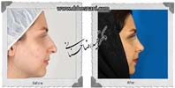  جراحی بینی -1020