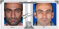  جراحی بینی -1021