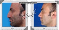  جراحی بینی -1022