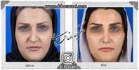  جراحی بینی -1023