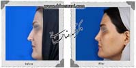  جراحی بینی -1024