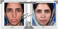  جراحی بینی -1025