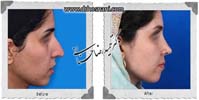  جراحی بینی -1026