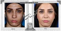 عمل بینی شماره 1027گوشتی با غضروف های قوی