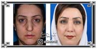 عمل بینی شماره 1031